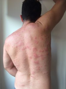 Suffering from chronic urticaria