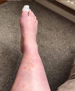 hives on leg5