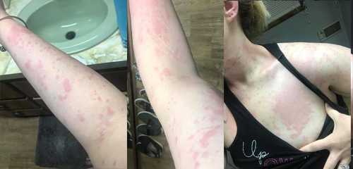 I developed these crazy hives in March
